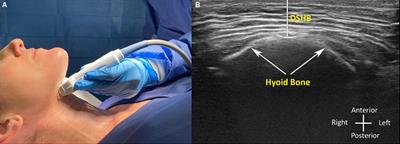 Pilot multicenter study to determine the utility of point-of-care ultrasound to predict difficulty of tracheal intubation using videolaryngoscopy with the McGrath™ Mac videolaryngoscope
